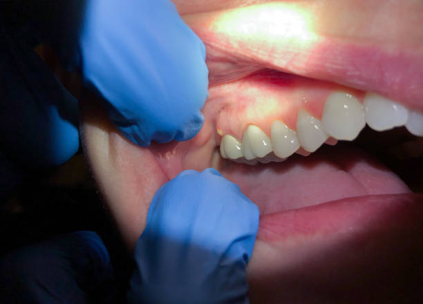 Best Emergency Tooth Extraction in Williston, ND